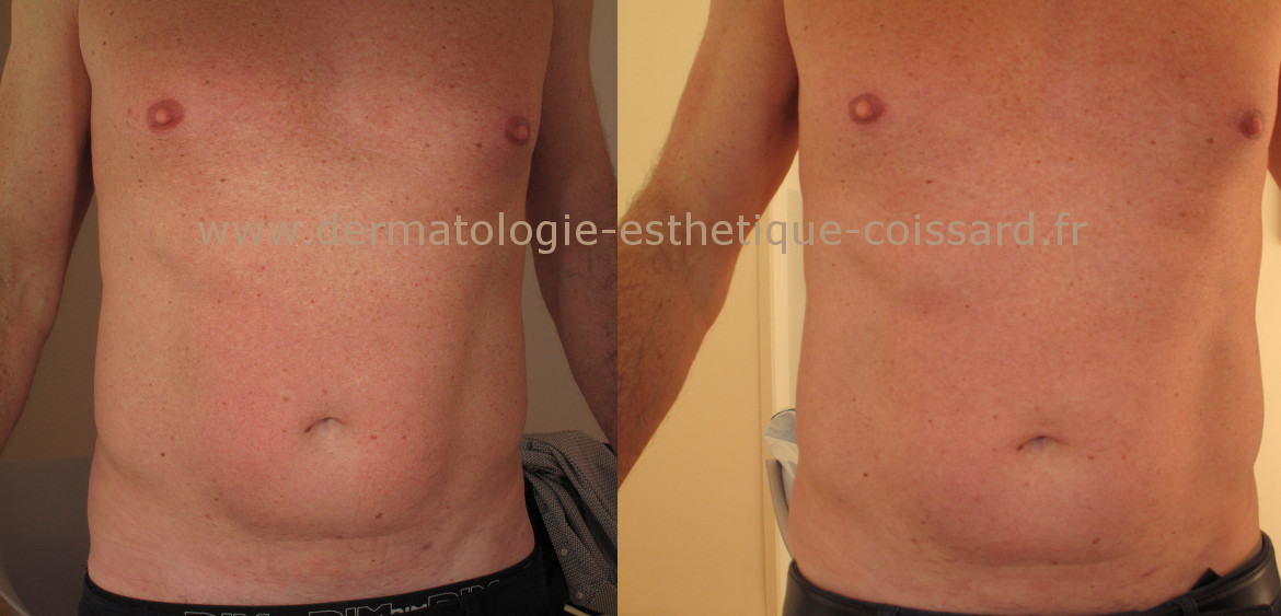 cryolipolysis-nice