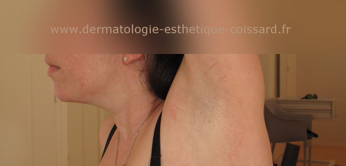 epilation-laser-beaulieu