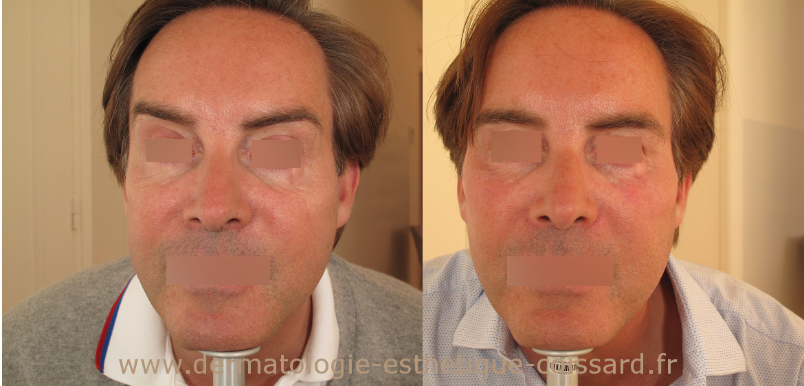 injection-botox-beausoleil