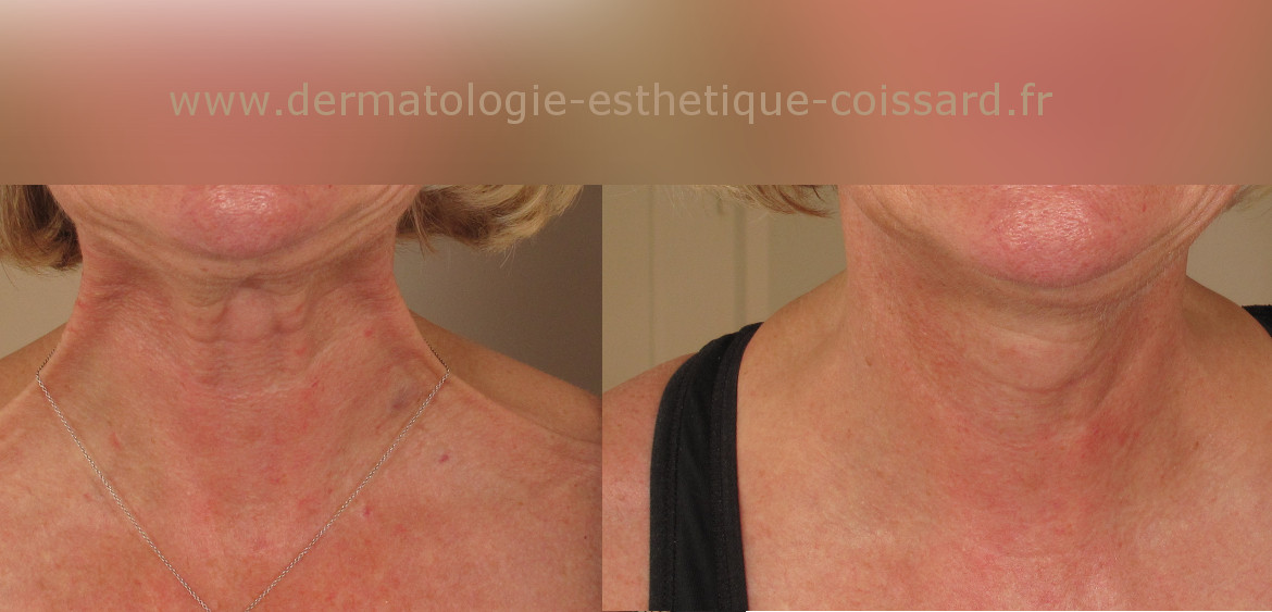 Fractional-laser-nice